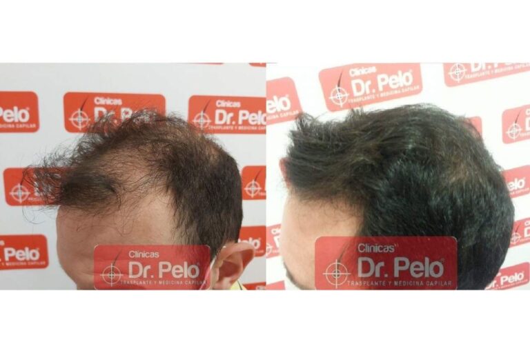 Señales de alopecia por Clínicas Dr. Pelo